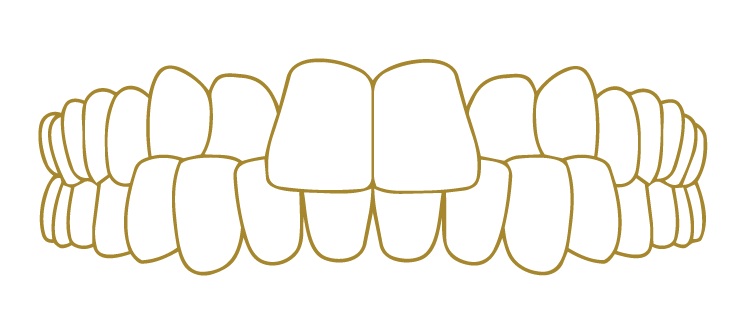 Cross Bite Smile Correction Gallery