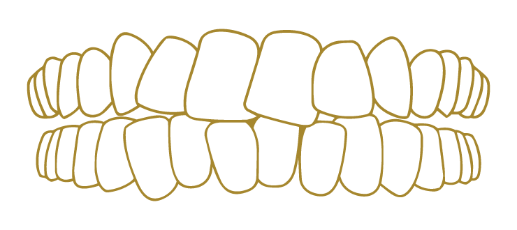 Teeth Crowding Smile Gallery