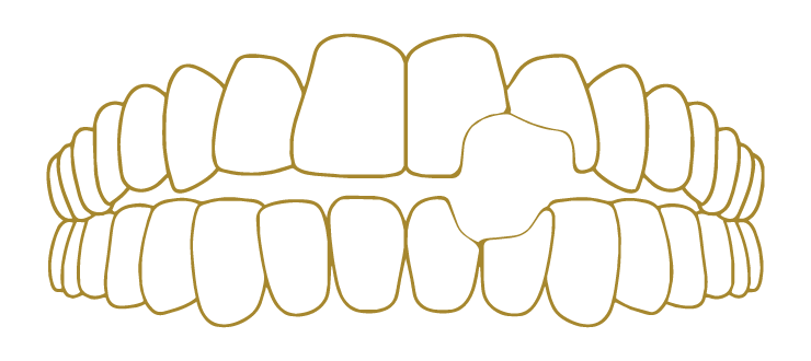 Tooth Decay Restoration Gallery
