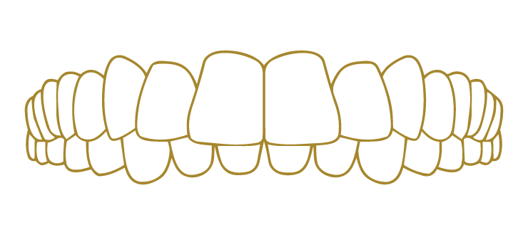 Deep Bite Smile Correction Gallery