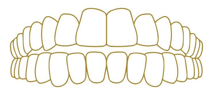Open Bite Smile Correction Gallery