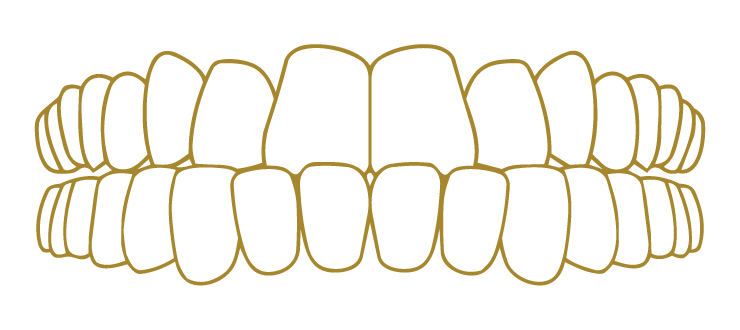 Under Bite Smile Correction Gallery