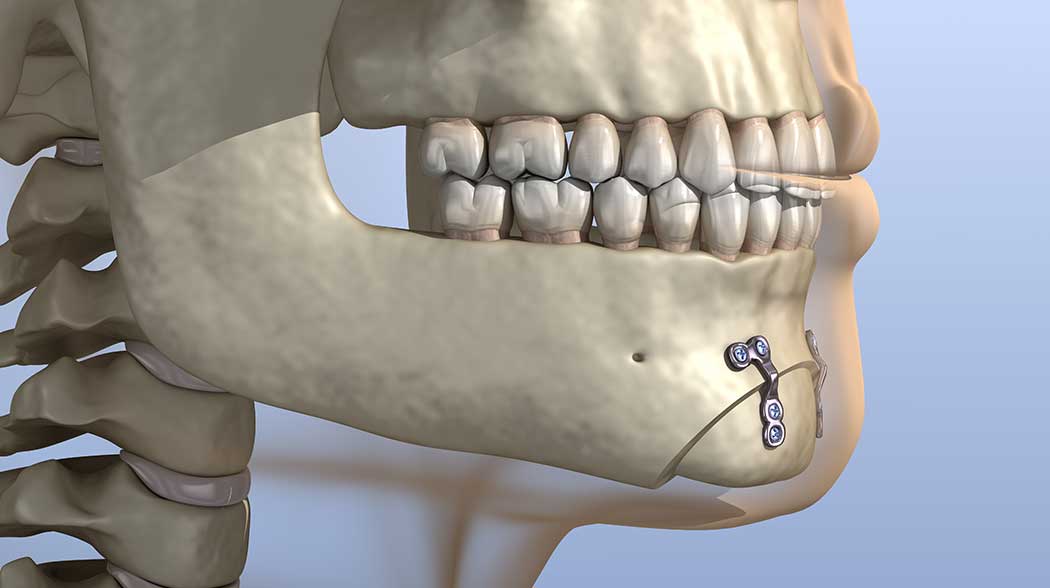 Osseous Surgery Pocket Reduction for Gum Disease in Tacoma, WA