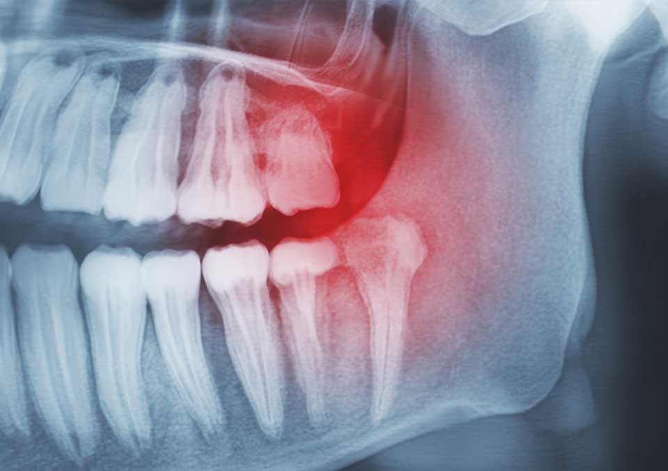 Gentle Wisdom Teeth Removal and Impacted Molar Extraction in Tacoma, WA