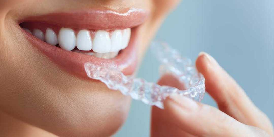CandidPro Clear Aligners in Tacoma