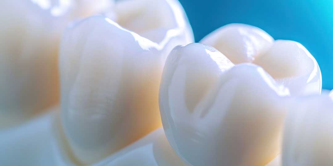 Same-Day Ceramic Dental Crowns in Tacoma