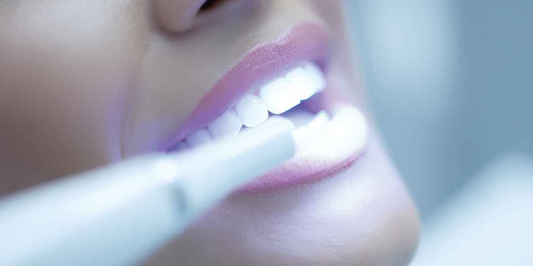 Professional Teeth Whitening in Tacoma