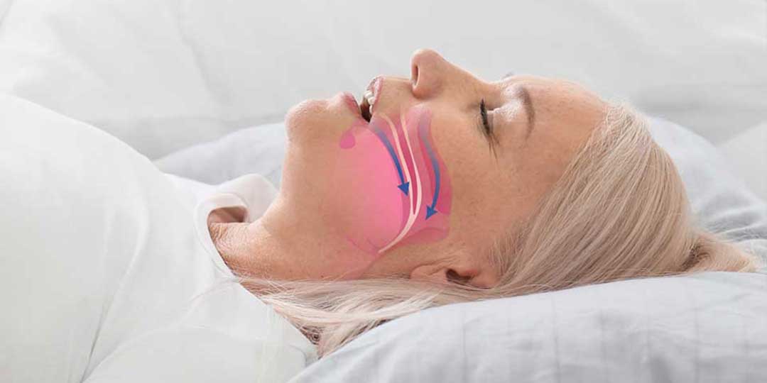 Sleep Apnea Dental Treatment in Tacoma