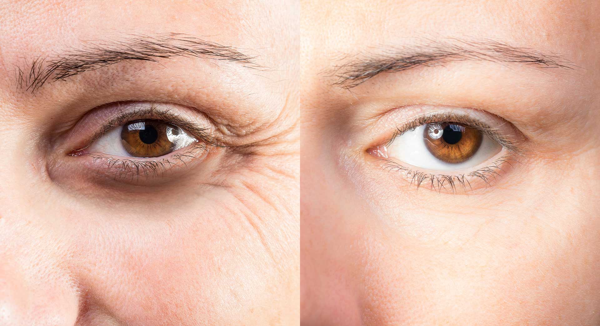 Fotona EyeLase Non-Surgical Laser Eye Rejuvenation in Tacoma, WA