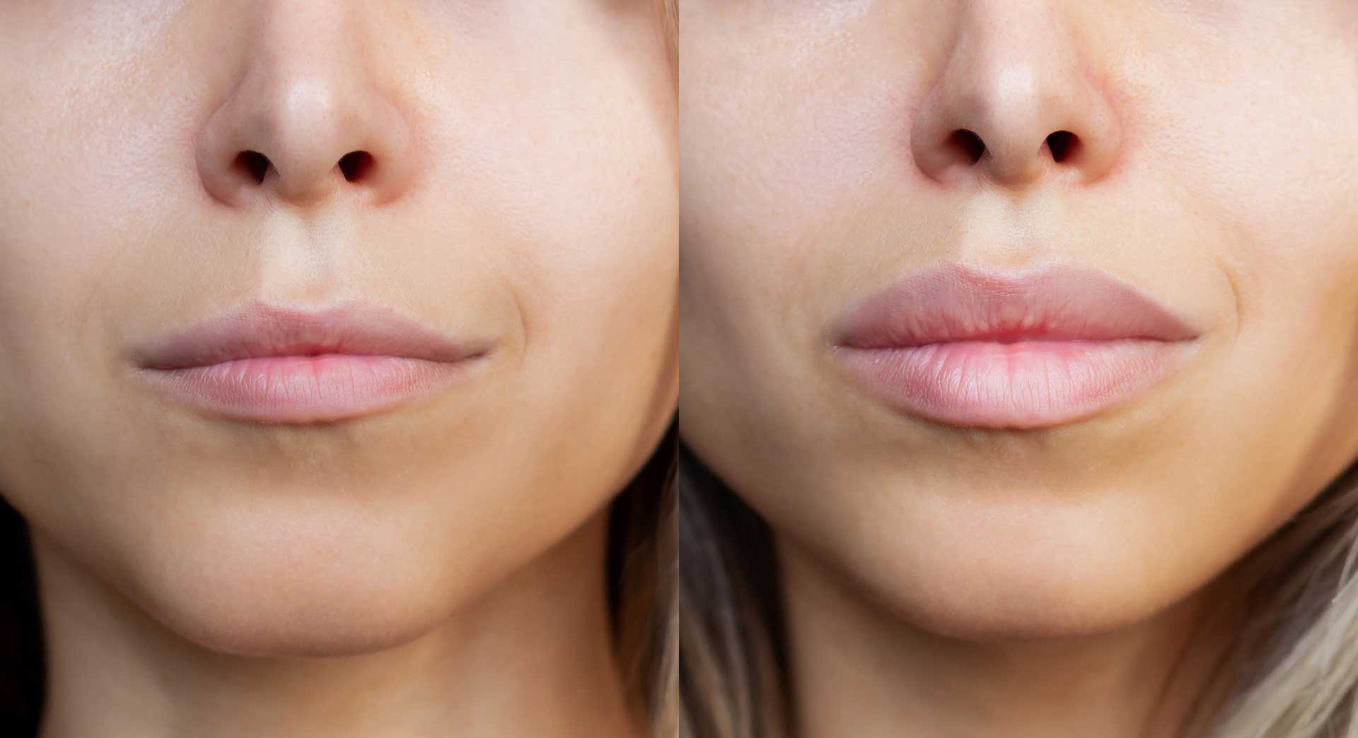 Fotona LipLase Needle-Free Laser Lip Plumping in Tacoma, WA